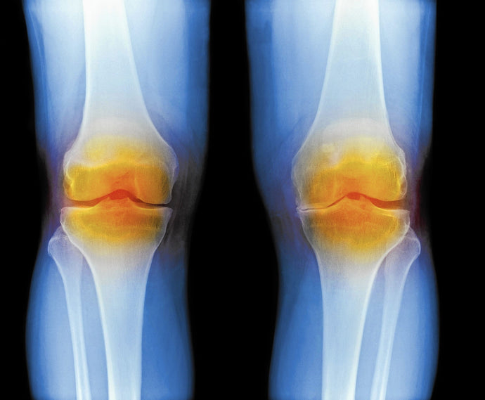 Treatment of Knee Osteoarthritis with Intraarticular Umbilical Cord-Derived Wharton's Jelly: A Case Report